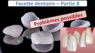 Facette dentaire  Problèmes possibles  Guide complet  partie 8 [upl. by Euginom694]