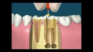 Endodontics Root Canal Treatment [upl. by Ees]