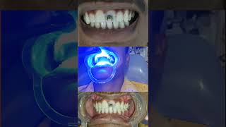 Front tooth composite filling for caries tooth brokenteeth compositefilling [upl. by Kitrak]