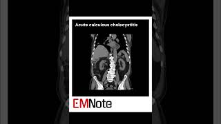 Acute Cholecystitis medical [upl. by Grube]