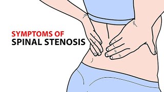 Symptoms of Spinal Stenosis [upl. by Olivette174]