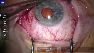 Pterygium Removal Surgery [upl. by Tailor]