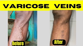 Laser treatment of varicose veins Diode laser ablation of varicose veins Varicose veins treatment [upl. by Michiko820]