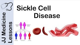 Sickle Cell Disease  Pathophysiology Symptoms and Treatment [upl. by Bartle]