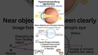 Far sightedness or hypermetropia class 10 class10 physics humaneye hypermetropia convexlens [upl. by Eryn]