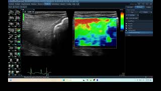 IQ 277 LIVER ELASTOGRAPHY HEPATOMA ECHOPAC ANALYSIS ULTRASOUND [upl. by Shena]