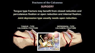 Fractures Of The Calcaneus  Everything You Need To Know  Dr Nabil Ebraheim [upl. by Marietta]