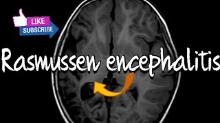 Rasmussen encephalitis CT [upl. by Naeruat]