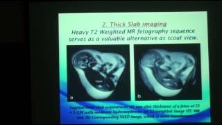 Role of fetal MRI in assessment of ventriculomegaly [upl. by Israel]