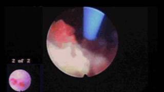 Bladder stone retrieval from dog [upl. by Merchant]