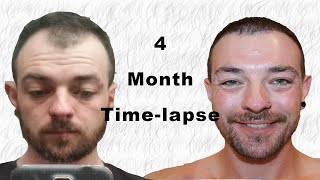 Hair Transplant Timelapse 04 months [upl. by Anayhd]