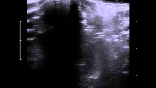 vitreous hemorrhage ultrasound [upl. by Blackmun]