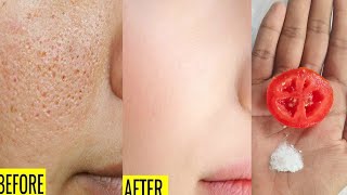 How to close pores permanently  Open pores Treatment at Home  How to shrink pores naturally [upl. by Stetson]