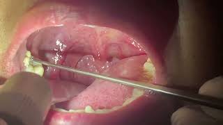 How to remove Tonsil Stones  Immediate Relief after TONSIL STONE Removal [upl. by Kaleb]