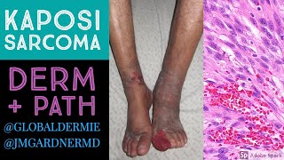 Kaposi Sarcoma DermatologyPathology Collaboration by globaldermie amp JMGardnerMD [upl. by Barnet774]