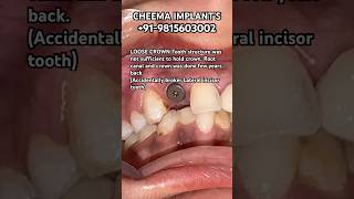 Front teeth Incisor root canal loose crown extraction procedure implant placed amp zirconia tooth [upl. by Lekcar847]