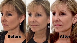 How to Get Rid of Jowls with Dermal Fillers Step 3 [upl. by Moore690]