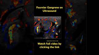 Fournier gangrene radiology radiologyresident medicine ultrasound dermatology [upl. by Keare]