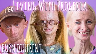 Living With Progeria 30 Min Documentary  BORN DIFFERENT [upl. by Nnewg]