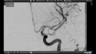 How Endovascular Stroke Treatment Works [upl. by Auod934]