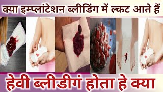 Kya Implantation bleeding me clots aate hai।Heavy Bleeding hoti hai।Implantation Bleeding Vs Periods [upl. by Onez749]