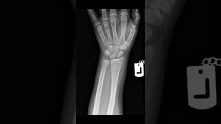 Colles fracture xraywrist [upl. by Romilly]