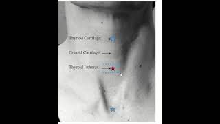 Living anatomy of Isthmus of thyroid gland [upl. by Yreffoeg]