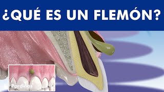 El absceso dental  Qué es un FLEMÓN y cómo se cura la infección con pus © [upl. by Repooc247]