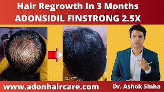 Hair Regrowth In 3 Months  Adonsidil Finstrong 25x Results  Minoxidil  Dr Ashok Sinha [upl. by Jankey652]