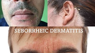 Seborrheic dermatitis  treatment health [upl. by Evered]