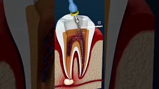 Root canal treatment for infected tooth STEP BY STEP rootcanal implantprocedure infectedtooth [upl. by Yblocaj]