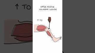 Motor lesions [upl. by Eixela]