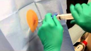 Bone marrow extraction [upl. by Web]