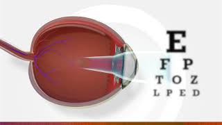 What is myopia  3D animation of myopia [upl. by Cahra]