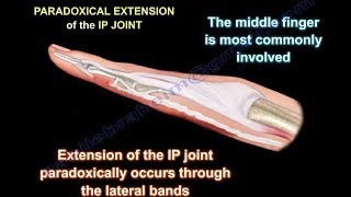 Lumbrical Plus Finger  Everything You Need To Know  Dr Nabil Ebraheim [upl. by Hendrick185]