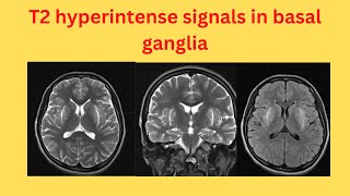 T2 hyperintense signals in basal ganglia [upl. by Tybald]