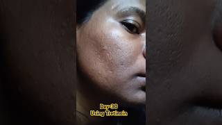 Day30 Using Tretinoin 0025 Cream viralvideo tretinoin skincare shorts youtubeshorts [upl. by Fuchs268]