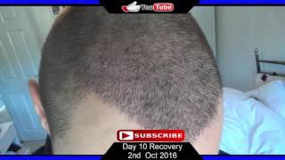 FUE Hair Transplant Day 10 Post Op Recovery [upl. by Nehemiah]