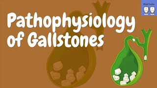 Gallstones Pathophysiology Cholecystitis Choledocholithiasis Diagnosis ComplicationsTreatment [upl. by Edlihtam]