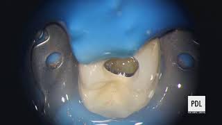 Live Stream Molar Endodontic Treatment Video Complex Anatomy with Detailed Narrative [upl. by Pallua939]