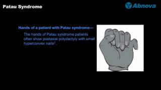 Patau Syndrome [upl. by Klinges]