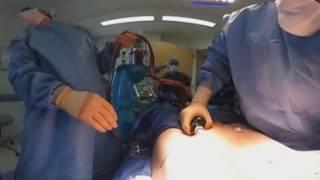 Abdominal Liposculpture  Best 360 Videos  Surgery 360 [upl. by Dora926]