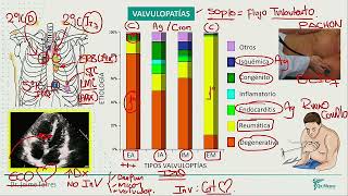 Valvulopatias Estenosis Aortica Insuf Aortica Estenosis Mitral Insuficiencia [upl. by Ruhtracm672]