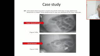 Case 128 fixed dilated bowel indicate dead bowel NEC necrotising enterocolitis surgical emergenc [upl. by Idoj767]