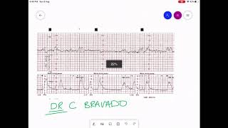 CARDIOTOCOGRAPHY  CTG INTERPRETATION [upl. by Lance828]