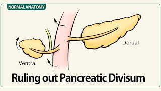 Ruling out Pancreatic Divisum [upl. by Freud]