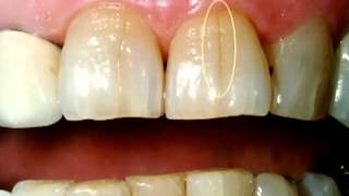 Dentist  Cracked Tooth Crown Procedure [upl. by Dermott]