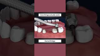 missing teeth replacement permanent method STEP BY STEP implantprocedure ceramicteeth crown [upl. by Dorelle394]