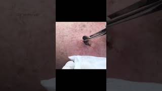 Blackhead New Years Pop [upl. by Mcconnell]