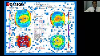 Interpretation of Corneal Topography [upl. by Emirac824]